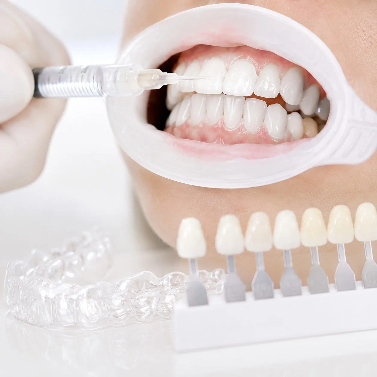 Clareamento dental supervisionado na Odonto Siim em Anápolis