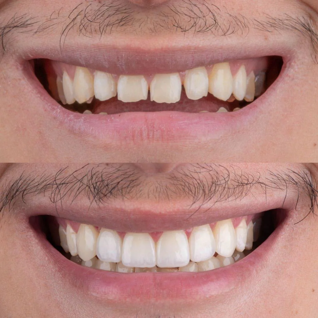 Caso clínico antes e depois do sorriso