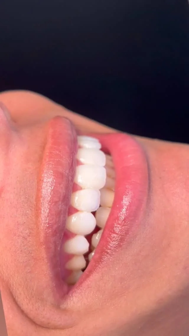Close clínico de sorriso e resultado estético