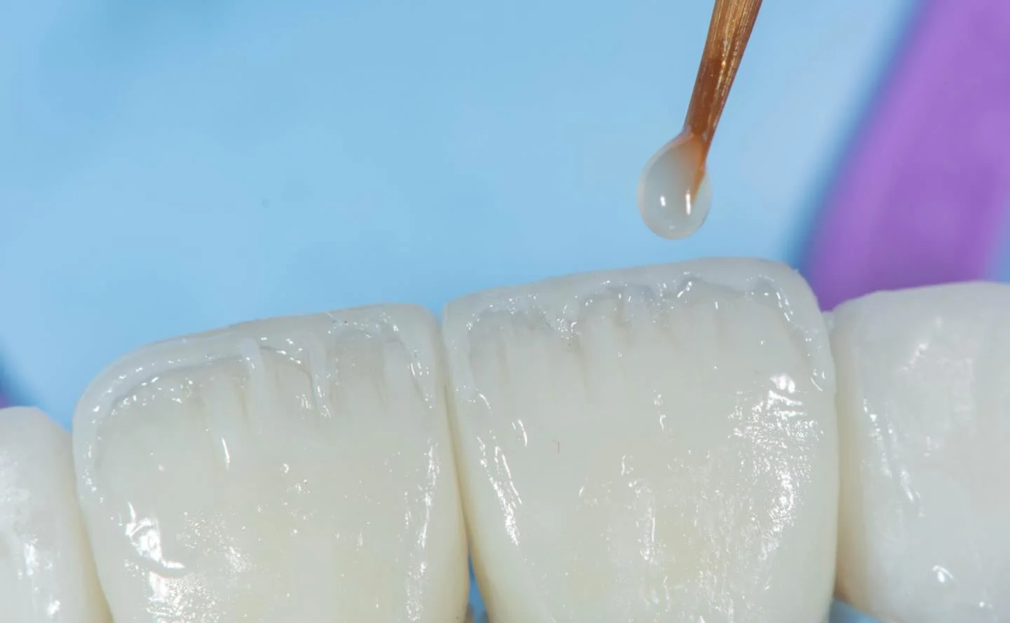 Aplicação clínica de material restaurador em dente