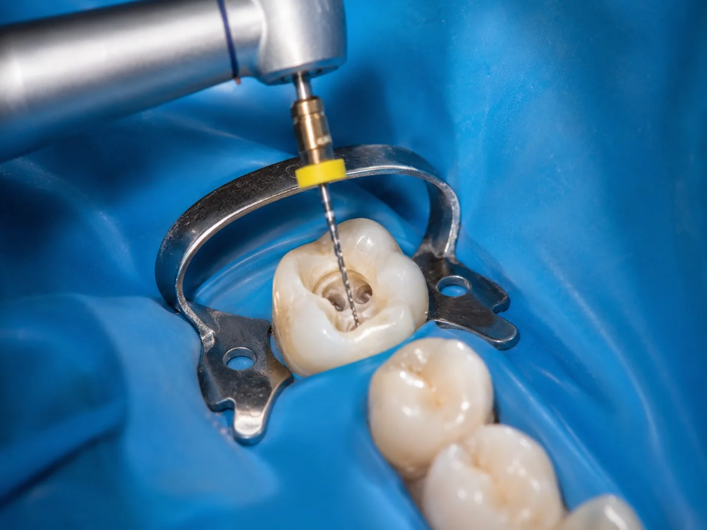 Tratamento de canal e Endodontia na Odonto Siim em Anápolis
